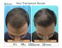 Get Natural, Permanent Hair Restoration by Dr. Jangid