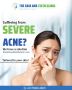  Tired of Struggling with Acne? 