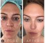 Professional Microneedling in Kingston, Ontario