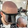 What Is the Recovery Time After Scalp Micropigmentation Lond