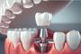Best Dental Implant in Mumbai at Smile Again Dental Clinic