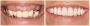 Restore Your Smile with All on Four Dental Implants