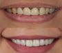 Achieve a Flawless Smile with Porcelain Veneers Dentist Lond
