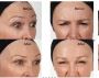 Anti Wrinkle Treatment Toorak, Glen Iris, Camberwell