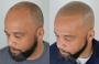 Scalp Micropigmentation California – Natural Hair Loss Solut