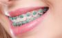 Ceramic Braces Treatment in Chelsea | Reliable Braces