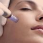 Glow Naturally with Nano-Pen Facial at Solterra Spa 