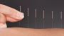 Fertility Acupuncture Clinic in Calgary