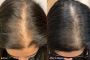 KeraLase Hair Restoration Clinic in Gilroy
