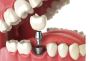 Southwest Family Dentistry | Local Dental Implant Restoratio