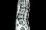 Spinal Deformity Correction by Dr. B. Leela Prasad