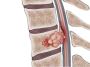 Spinal Cancer Treatment & Tumor Specialist in Delhi, India