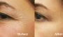 Best Treatment For Wrinkles