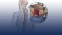 Stem Cell Transplantation for Multiple Myeloma