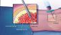 Severe Aplastic Anemia Bone Marrow Transplant