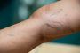 What are the Treatment Options for Varicose Veins? 