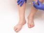 Are varicose veins covered by insurance?