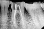 Gentle & Effective – Best Root Canal Treatment in Ahmedabad 