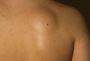 lipomas treatment in bangalore