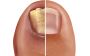 No Surgery Bunion Treatment | Sydney Foot Solutions