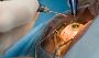 Best lens for Cataract surgery | mghospital