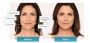 Radio Frequency Skin Tightening