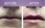Juvederm Specials In Near Me