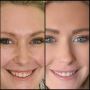 Neuromodulator Treatment Orange County Smooth Lines Fast