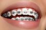 Get Perfectly Aligned Teeth with Braces