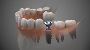 Best Full Mouth Dental Implant Service in Kolkata
