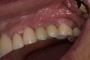 Wisdom teeth removal Tijuana