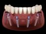 All on 4 dental implants Tijuana Mexico