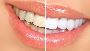 Painless Teeth Whitening | Safe & Comfortable Whitening Solu