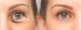 Smoother, Firmer Skin with RF Treatment for Wrinkles Smoother, Firmer Skin with RF Treatment for Wrinkles