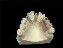 Premium Quality China Implant Crowns