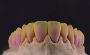 High-Quality Dental Attachments at Factory Prices