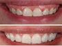 Gummy Smile Treatment in Noida
