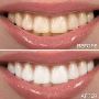 Teeth Whitening in Noida Sector 104