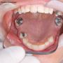 Full Mouth Rehabilitation in Noida