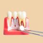 Root Canal Treatment specialist in Noida