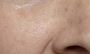 Open Pores Treatment in Ludhiana