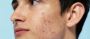 Effective Acne Scar Treatment in Ludhiana for Healthy skin