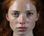 Melasma Treatment in Ludhiana | The Glo Medispa Clinic