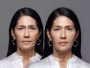 Hyaluronic Acid Injection for Wrinkles