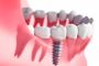 Quality Dental Implants Boronia- Regain Your Smile