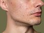Acne Treatment in Lucknow