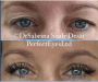 Upper Eyelid Blepharoplasty