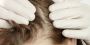 Dallas Hair Loss Solutions