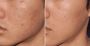 Holistic Skin Rejuvenation: Facial Acupuncture...