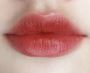 Enhance Your Lips With the Best Lip Augmentation Toronto